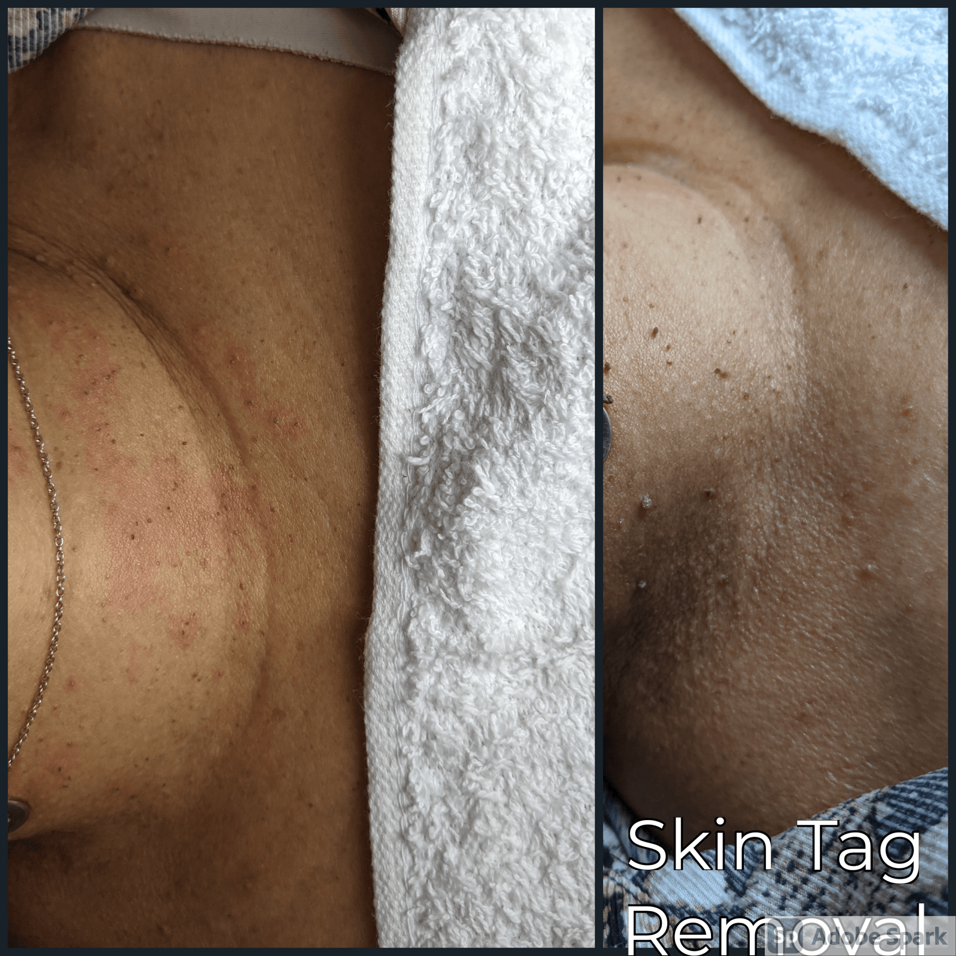 Skin Tag Removal -Before & After Pic