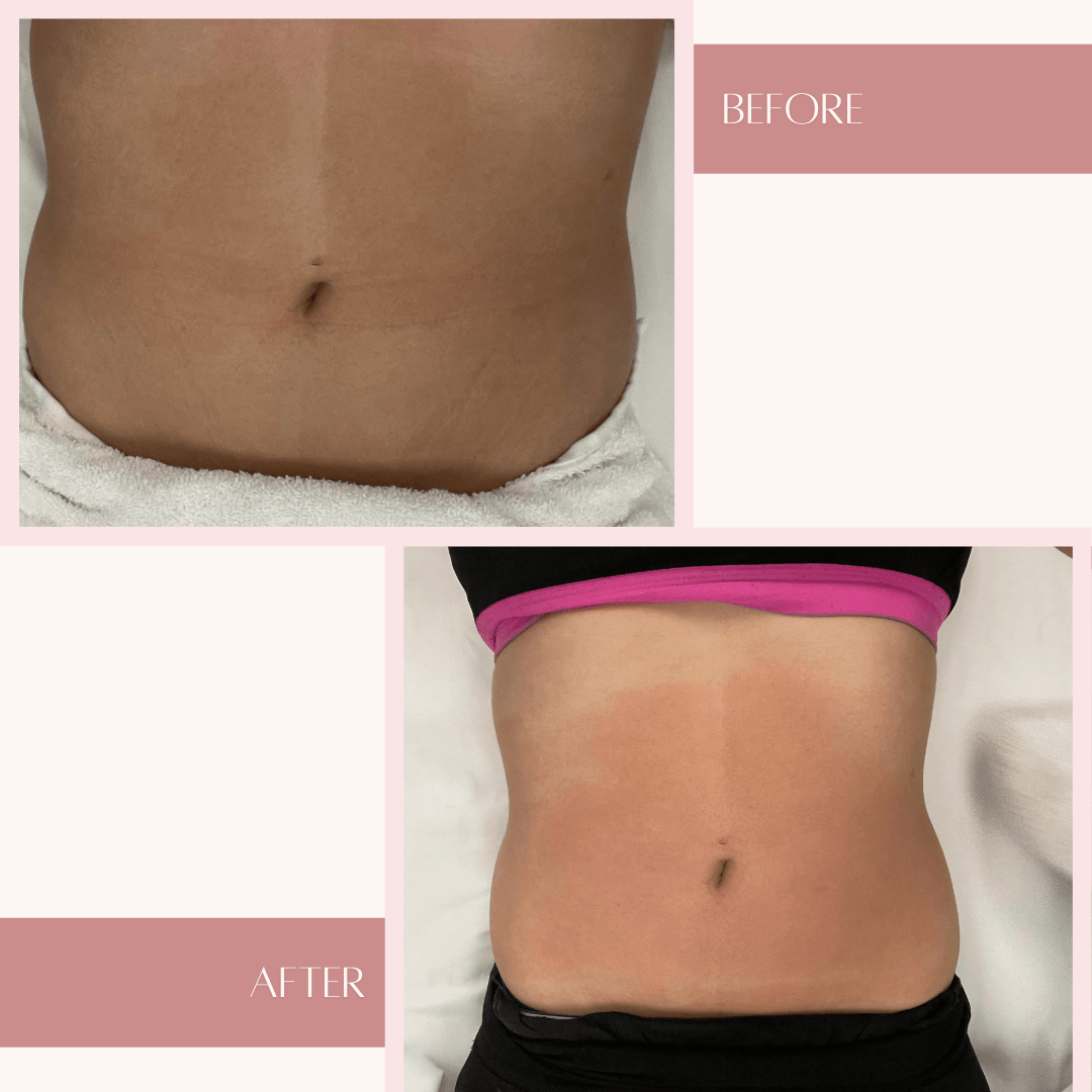 Body Sculpting & Body Contouring Body Sculpt For Thighs, Waist & Hips