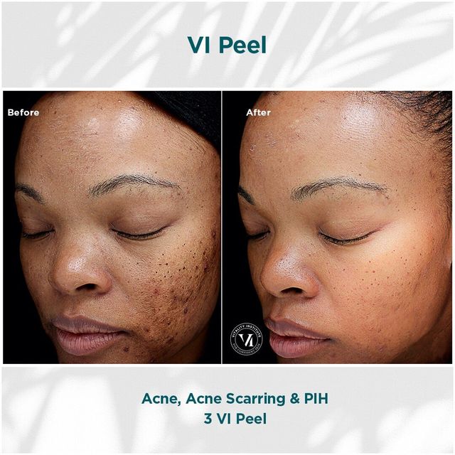 Chemical Peels Philadelphia Pa | Facial peel to help improve skin