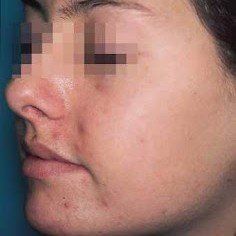 Acne treatment for face