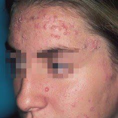 A close up of a woman 's face with acne on it.