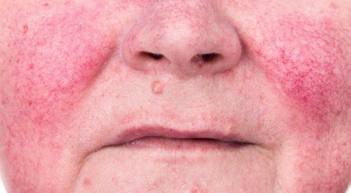 What-is-rosacea-and-how-to-treat-maxaesthetics