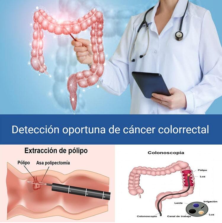 DR. TOMAS H. MÉNDEZ GUTIÉRREZ - CANCER COLORRECTAL