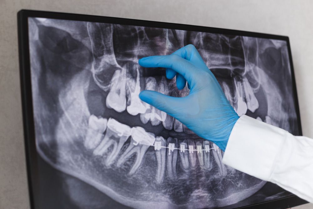 A Dentist Is Holding An X-ray Of A Person 's Teeth — Dentist On Tweed in Tweed Heads, NSW