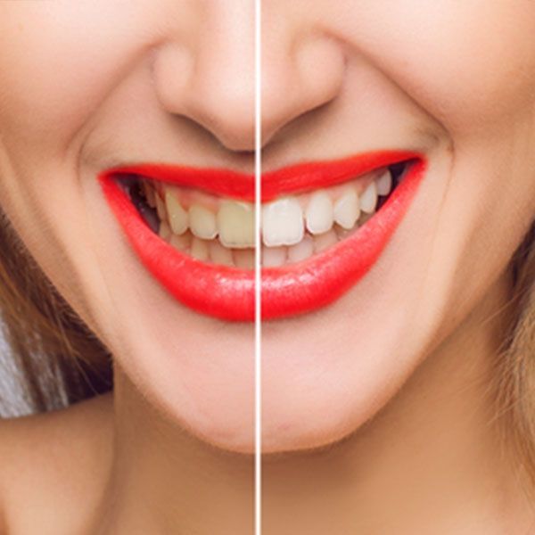 Before And After Photo Of A Woman's Smile — Dentist On Tweed in Tweed Heads, NSW