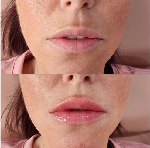 A before and after photo of a woman 's face