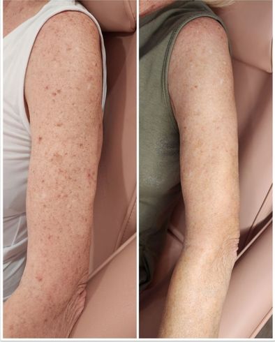 A before and after photo of a woman 's arm