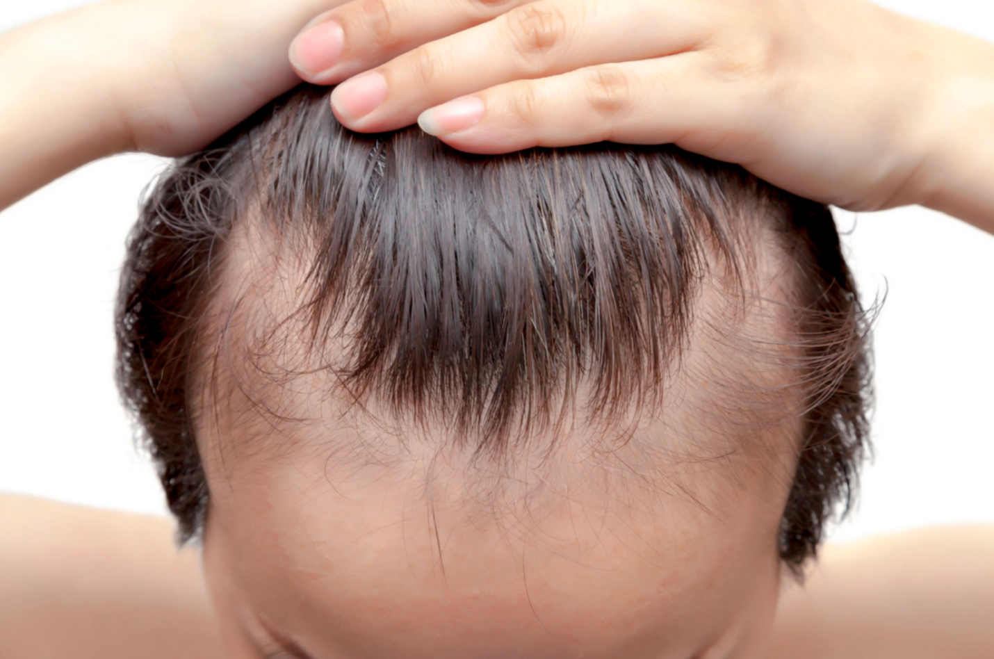 Person's head with thinning hair; hands on top of head, showing receding hairline and bald patch.
