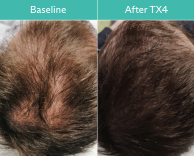 Comparison of male scalp, before and after TX4 treatment, showing increased hair density and coverage.