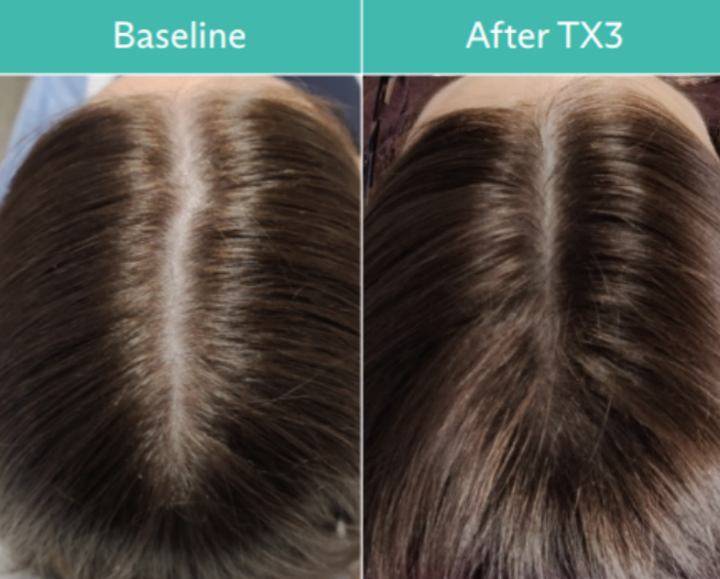 Two overhead views of a woman's scalp. Left: baseline thinning hair. Right: After TX3, thicker hair.