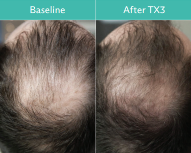Comparison of male balding scalp: baseline thinning vs. improved hair growth after TX3 treatment.