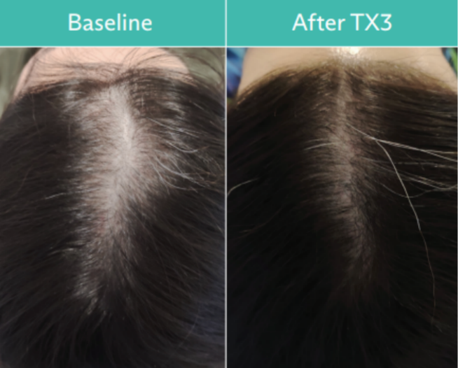 Comparison of a woman's scalp with hair loss (left) and after TX3 treatment (right), showing increased hair density.