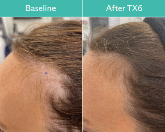 Comparison of a receding hairline before (left) and after TX6 treatment (right), with hair growth evident.