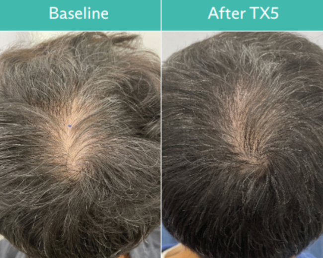 Comparison of thinning hair before and after TX5 treatment, showing improved hair density.