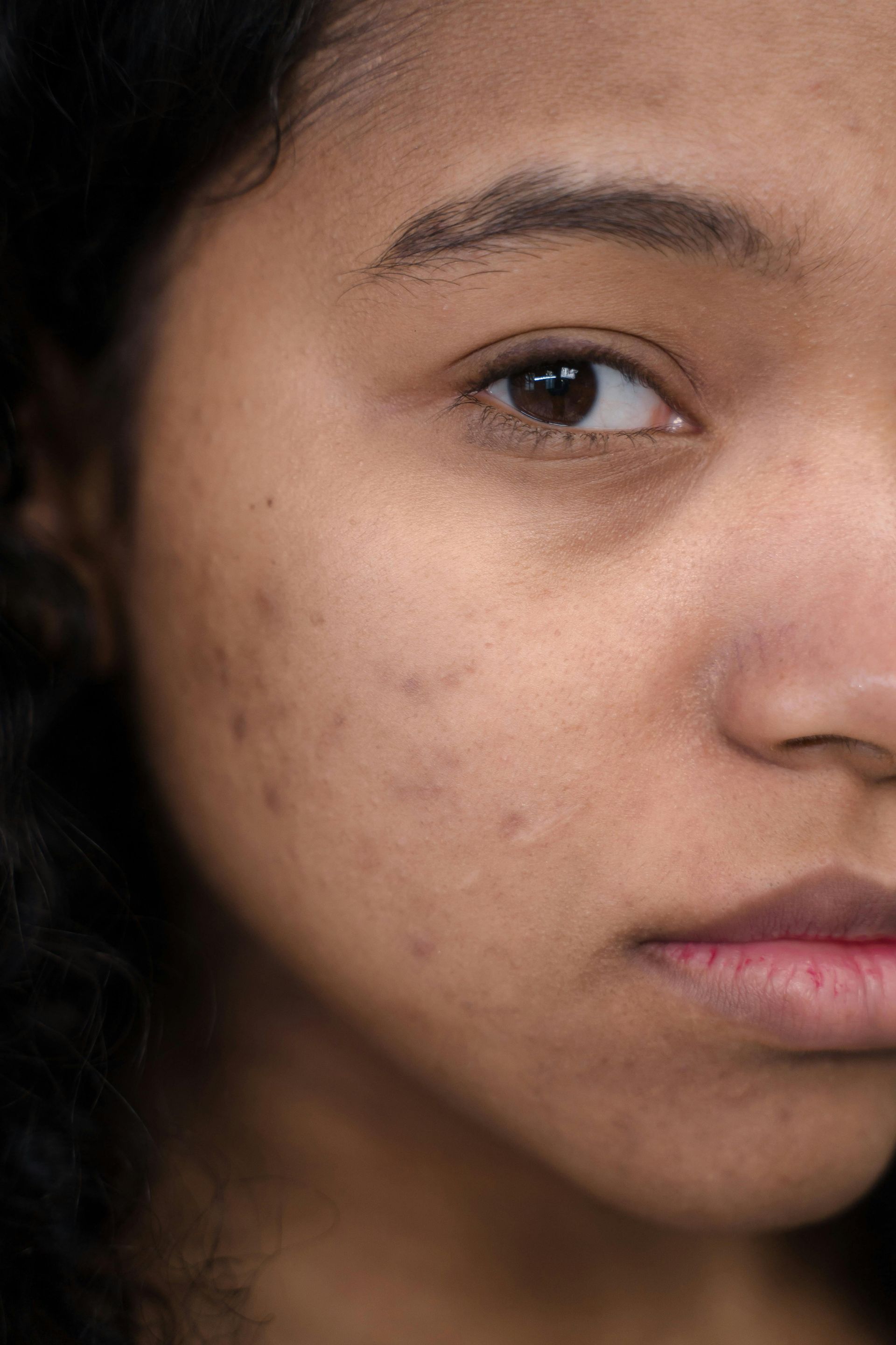 Close-up of a woman's face with dark skin, looking toward the viewer. She has acne scars and dark circles.