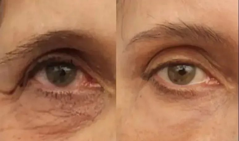 Tear trough, eyelid filler, morpheus8, plasma pen before and after, Monaco MedSpa, Miami, FL.