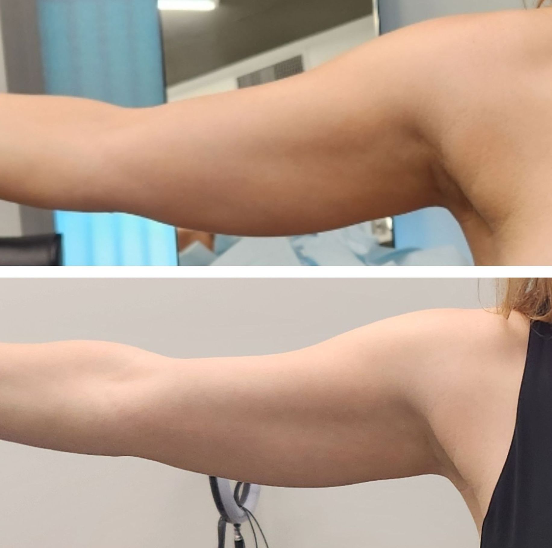 Morpheus8 arms, body contouring, body sculpting, microneedling with radiofrequency, Before and After, Monaco Medspa in Midtown Edgewater Miami, FL, Photos of Before and After Morpheus8, Monaco med spa in Midtown Edgewater Miami, FL