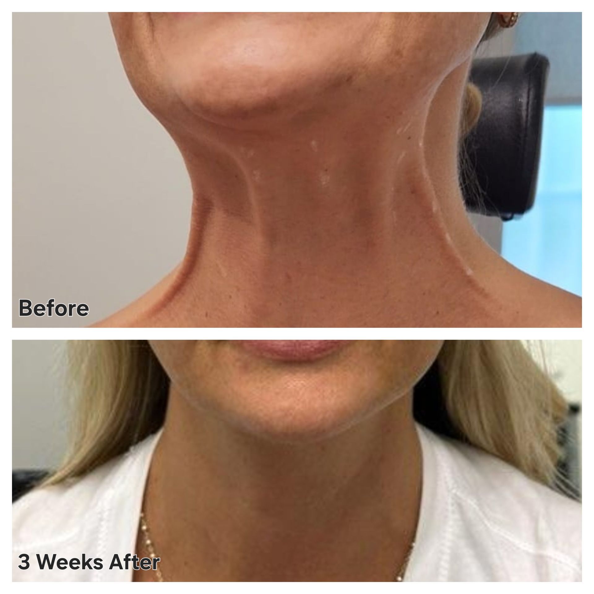 Before and After Photo of a Non-Surgical Neck Lift done with Neck Botox by Dr. Barrueta at Monaco Med Spa in Midtown Miami, FL
