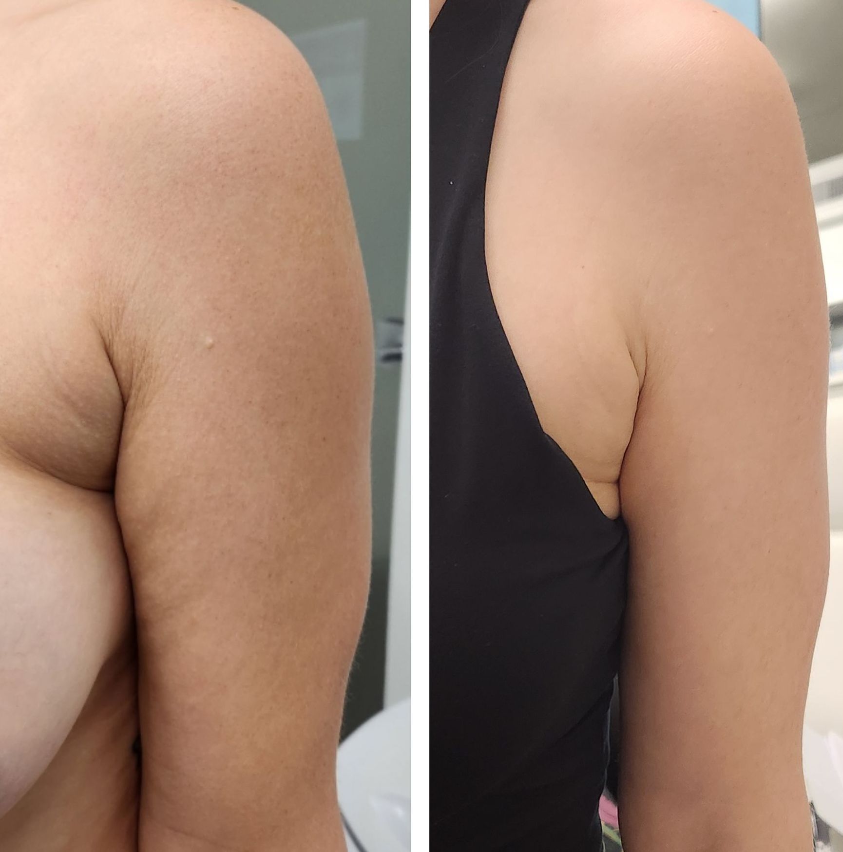 A before and after photo of a woman 's arm. 