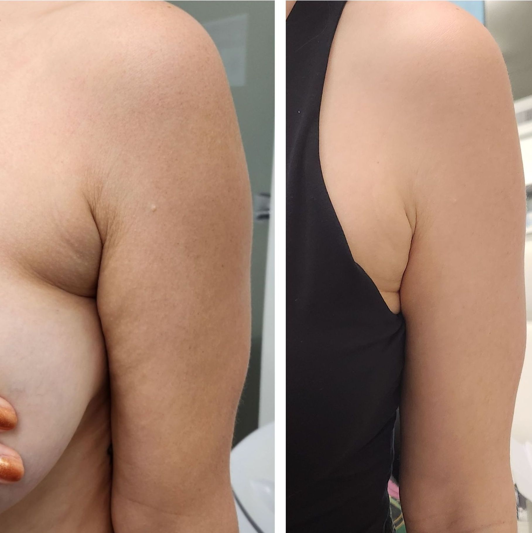 Morpheus8 arms, body contouring, body sculpting, microneedling with radiofrequency, Before and After, Monaco Medspa in Midtown Edgewater Miami, FL, Photos of Before and After Morpheus8, Monaco med spa in Midtown Edgewater Miami, FL