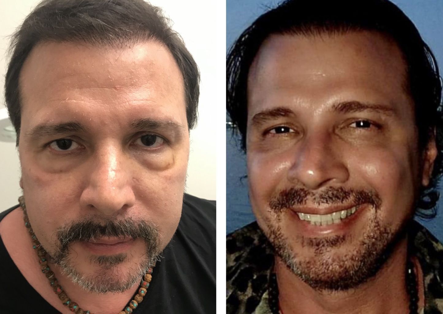 Facial Botox 
Before & 1 Month After All Treatments: One Face, Eyelids & Neck Morpheus8 Treatment, Two Lower Eyelid Plasma Pen Treatments, Three Hair Restoration PRP Treatments & Facial Botox To The Forehead, Frown Lines/Glabellar Region & Crow's Feet. Treatments Were Done 4 Weeks Apart. Final Treatment Was Facial Botox . Before and after photos of forehead, glabellar complex frown lines and crow's feet botox at Monaco med spa Downtown Miami, Midtown Miami, Ball Harbour, Fisher Island, West Palm Beach, Star Island, coral Gable, Key Biscayne, Coconut Grove, Miami Design District, Aventura, Brickell, Edgewater Miami, FL