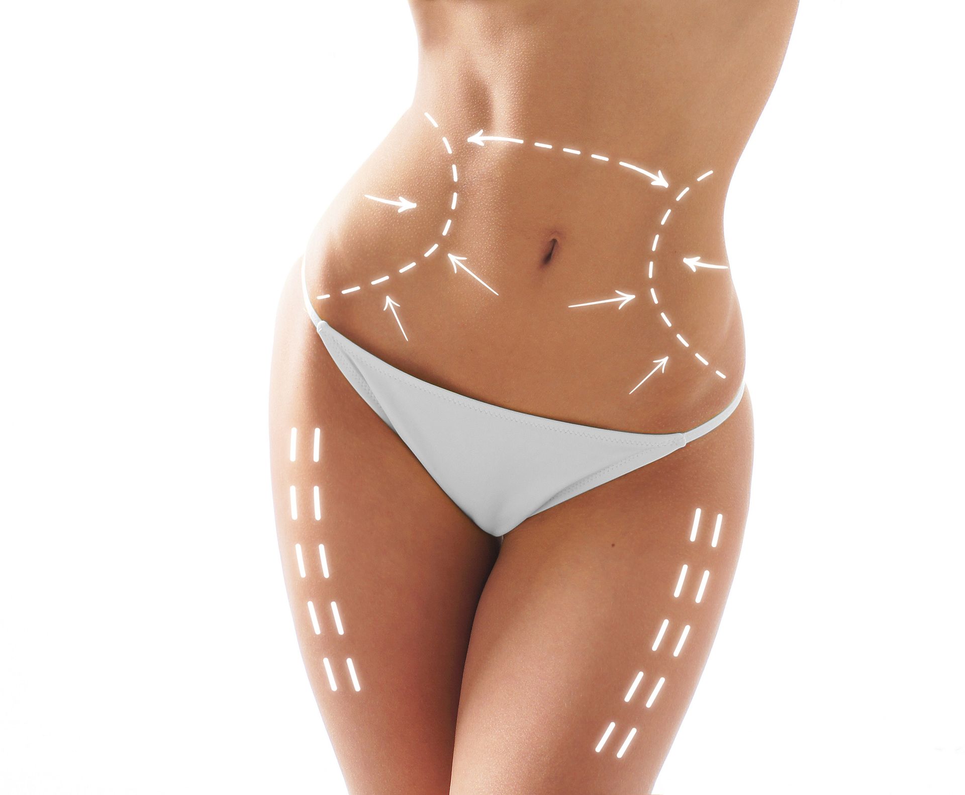 The Morpheus8 3D Body device handpiece being used for a non-surgical body contouring treatment