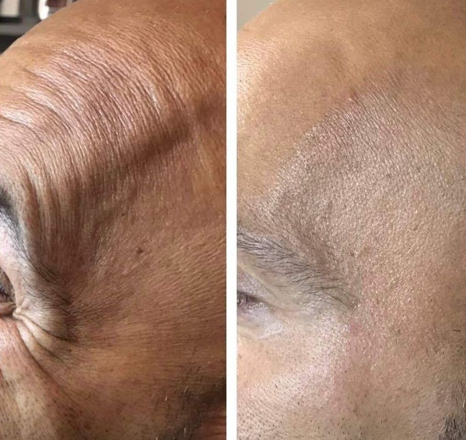 Photo of Before & 3 Weeks After male Botox Brotox at Monaco med spa in Midtown Miami, Fl in the neighborhoods of Edgewater Miami, Worldcenter Miami, and Midtown Miami