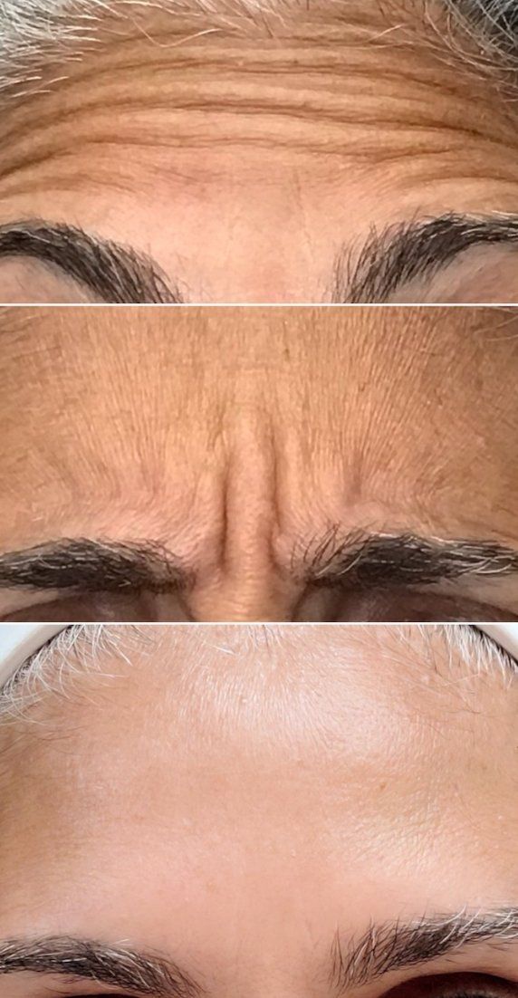 forehead botox, angry lines botox, frown lines botox, glabellar complex botox, 11's botox, botulinum toxin, dysport, botox, Before and After, Monaco Medspa in Midtown Edgewater Miami, FL, Photos of Before and After Botox, Dysport, Monaco med spa in Midtown Edgewater Miami, FL