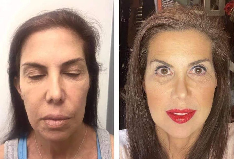 Monaco MedSpa, Miami, FL, Before and After of nonsurgical pdo thread threadlift face lift, face lift, Midtown miami, Edgewater Miami, FL, Facial Harmonization
Before & 1 Month After
PDO Thread Nonsurgical Facelift 
Cheek Filler
Marionette Lines Filler
Lip Filler Monaco med spa in downtown worldcenter edgewater midtown Miami, FL, photo of nonsurgical facelift with Morpheus8 Before and After, in Midtown Miami, Edgewater Miami, FL, microneedling with radiofrequency, at  Monaco med spa in Downtown Worldcenter Miami , Miami Design District, Miami Beach, Bal Harbour, Miami Edgewater Miami Midtown, South Beach, Aventura, Fisher Island, Star Island, FL