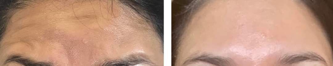 forehead botox, botox, dysport, Before and After, Monaco Medspa in Midtown Edgewater Miami, FL, Photos of Before and After Botox, Dysport, Monaco med spa in Midtown Edgewater Miami, FL