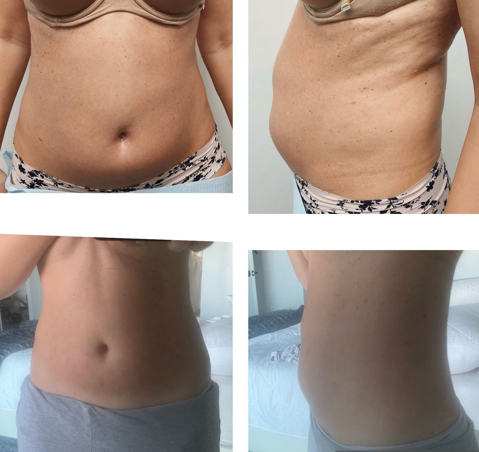 Morpheus8 abdomen and back, body contouring, body sculpting, microneedling with radiofrequency, Before and After, Monaco Medspa in Midtown Edgewater Miami, FL, Photos of Before and After Morpheus8, Monaco med spa in Midtown Edgewater Miami, FL