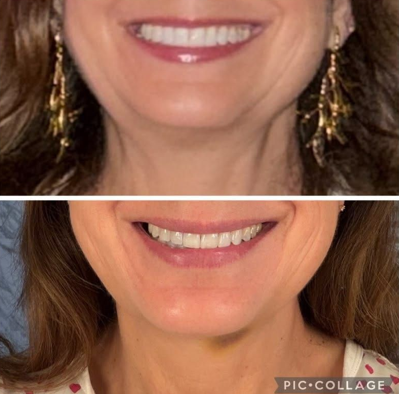 Before and after photo of btoox results one week after neck botox done by Dr. Barrueta at Moanco MedSpa, the best med spa in Miami, FL and the best botox medspa