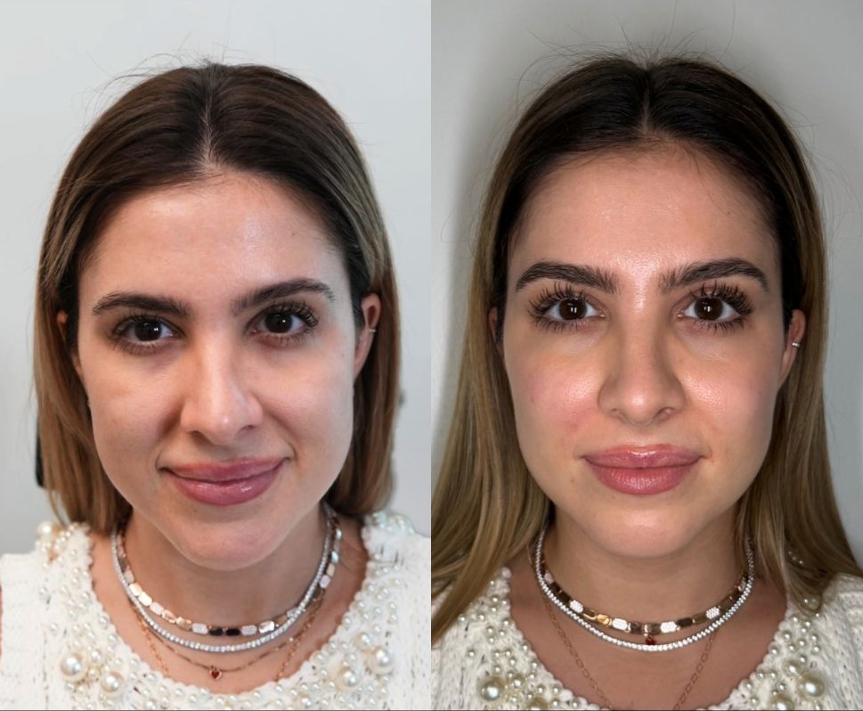 Photo of a client Before and Immediately After Nasolabial and Zygoma Filler performed by the best cosmetic doctor in Miami, FL at the best med spa in Miami, Monaco MedSpa