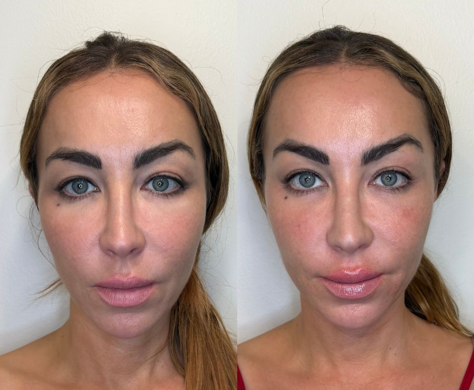 Photo of a client Before and Immediately After Jaw Contouring, Zygoma Cheek Filler and Lip Fillerperformed by the best cosmetic doctor in Miami, FL at the best med spa in Miami, Monaco MedSpa