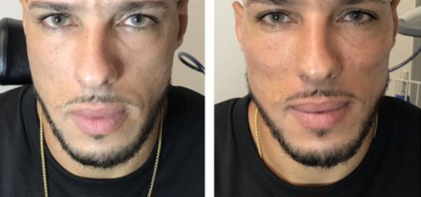 Before & Immediately After
Chin Filler, Cheek Filler Contouring, Jaw filler Contouring, jaw contouring, cheek contouring, Before and After, Monaco Medspa in Midtown Edgewater Miami, FL, Photo of Before and After Hyaluronic Acid Filler, Monaco med spa in Midtown Edgewater Miami, FL