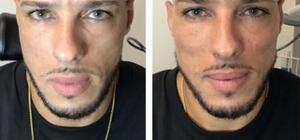 photo of Jaw Filler, Cheek Filler, Lip Filler, Monaco MedSpa, Miami, FL, edgewater miami, midtown miami, male botox, male fillers, brotox, jaw contouring, cheek contouring, before and after, radiesse, juvederm, restylane Monaco med spa in downtown worldcenter edgewater midtown Miami, FL