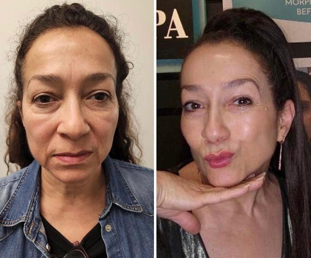 microneedling with radiofrequency, Before and After, Monaco Medspa in Midtown Edgewater Miami, FL, Morpheus8 Face, Morpheus8 Eyelids, Morpheus8 Neck, Facial Botox, Cheek Filler, Lip Filler, Plasma Pen To The Upper & Lower Eyelids, nonsurgical blepharoplasty, Photos of Before and After Morpheus8, Monaco med spa in Midtown Edgewater Miami, FL