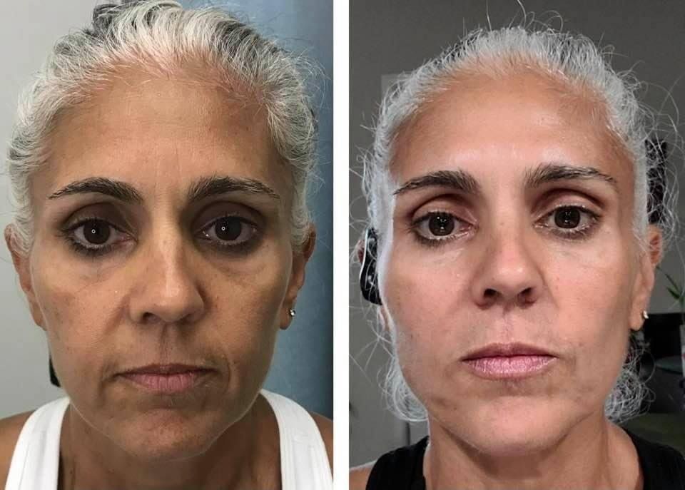 Monaco MedSpa, Miami, FL, Before and After, Midtown miami, Edgewater Miami, FL, Facial Harmonization
Before & 5 Weeks After
Nonsurgical PDO Thread Facelift
Forehead Botox & Chin Filler Monaco med spa in downtown worldcenter edgewater midtown Miami, FL, photo of nonsurgical facelift with pdo threads Before and After, in Midtown Miami, Edgewater Miami, FL, microneedling with radiofrequency, at  Monaco med spa in Downtown Worldcenter Miami , Miami Design District, Miami Beach, Bal Harbour, Miami Edgewater Miami Midtown, South Beach, Aventura, Fisher Island, Star Island, FL