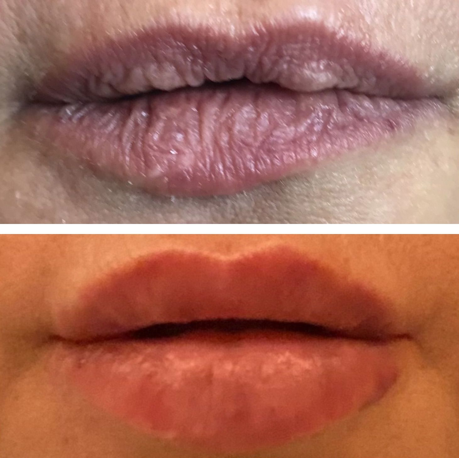 Lip Fillers in Miami, FL | Monaco MedSpa