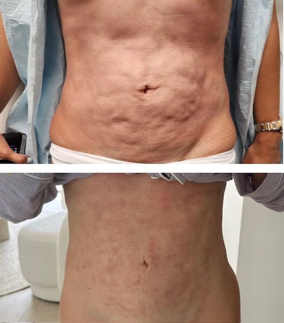 Morpheus8 abdomen, body contouring, body sculpting, microneedling with radiofrequency, Before and After, Monaco Medspa in Midtown Edgewater Miami, FL, Photos of Before and After Morpheus8, Monaco med spa in Midtown Edgewater Miami, FL