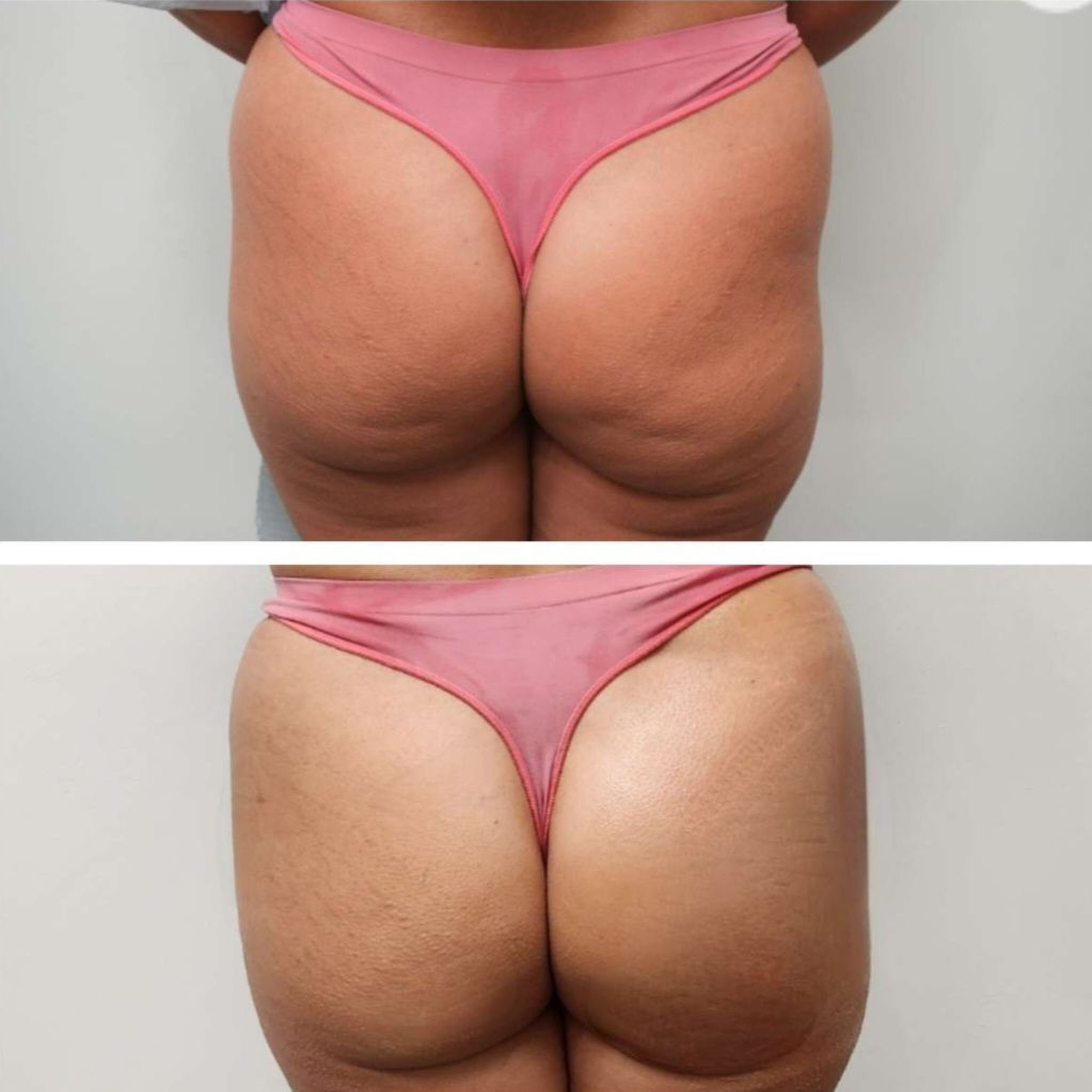 Before and after photo of Sculptra buttock butt lift,  a nonsurgical buttock butt lift done at Monaco med spa in Edgewater Midtown Downtown Brickell and Miami, FL