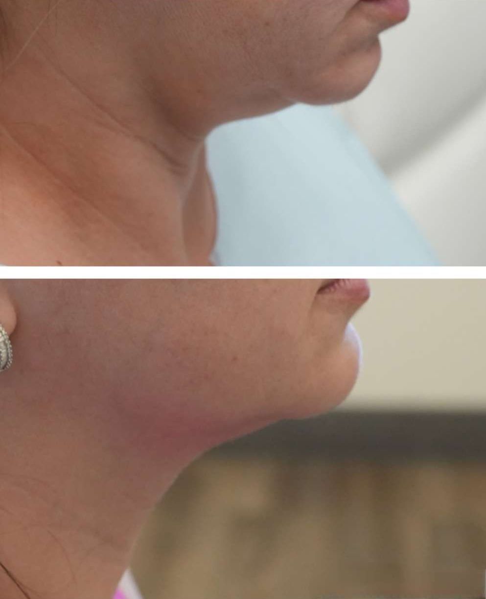 microneedling with radiofrequency, Monaco MedSpa, Miami, FL, Morpheus8, double chin, Before and After, Monaco Medspa in Midtown Edgewater Miami, FL, Photos of Before and After Morpheus8, Monaco med spa in Midtown Edgewater Miami, FL