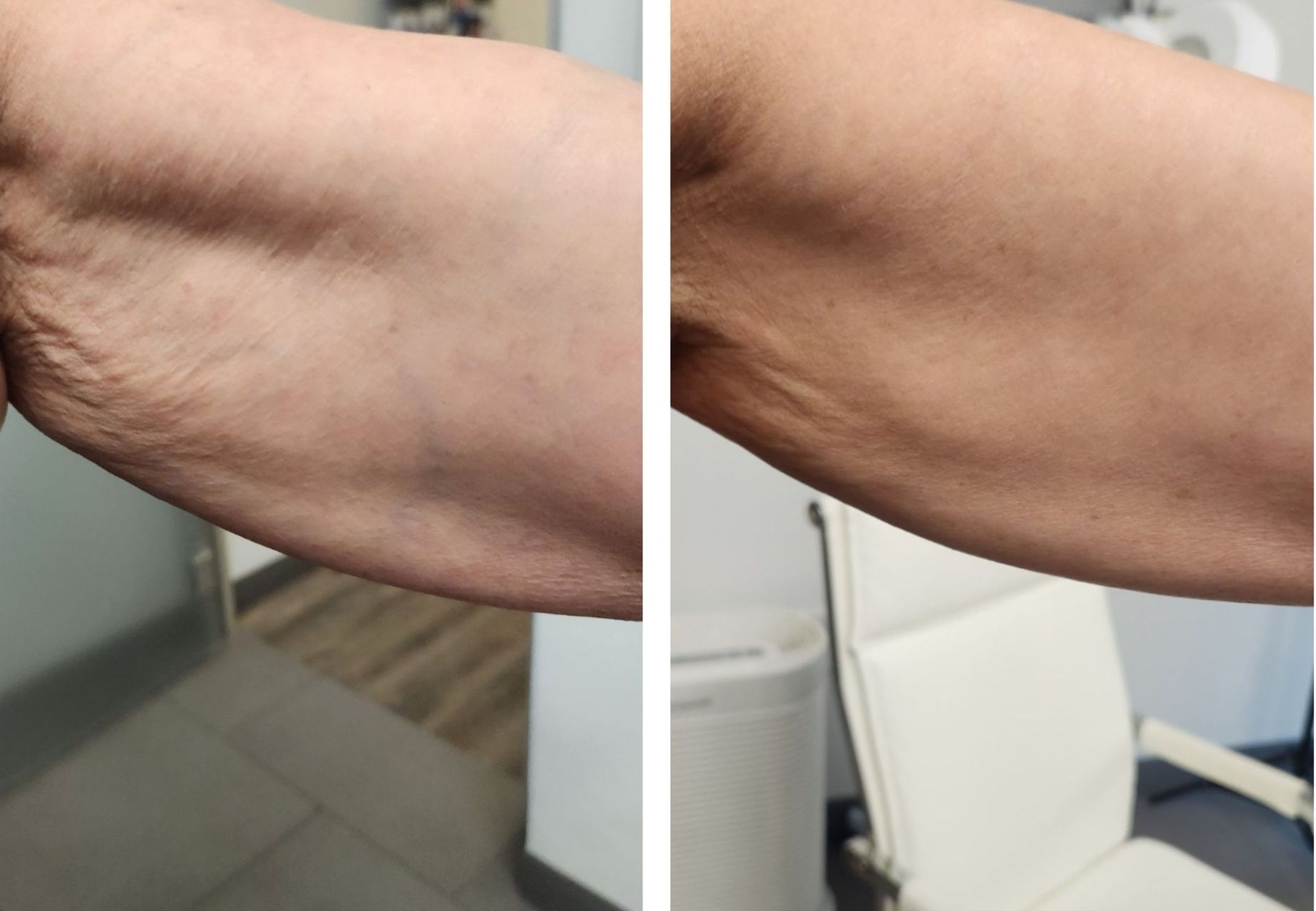 Monaco Med Spa, Miami, FL, photo of  Before and After, Midtown miami, Edgewater Miami, FL, Plasma Pen
Before & 3 Months After One Treatment Session to arms with Plexr Plasma Pen