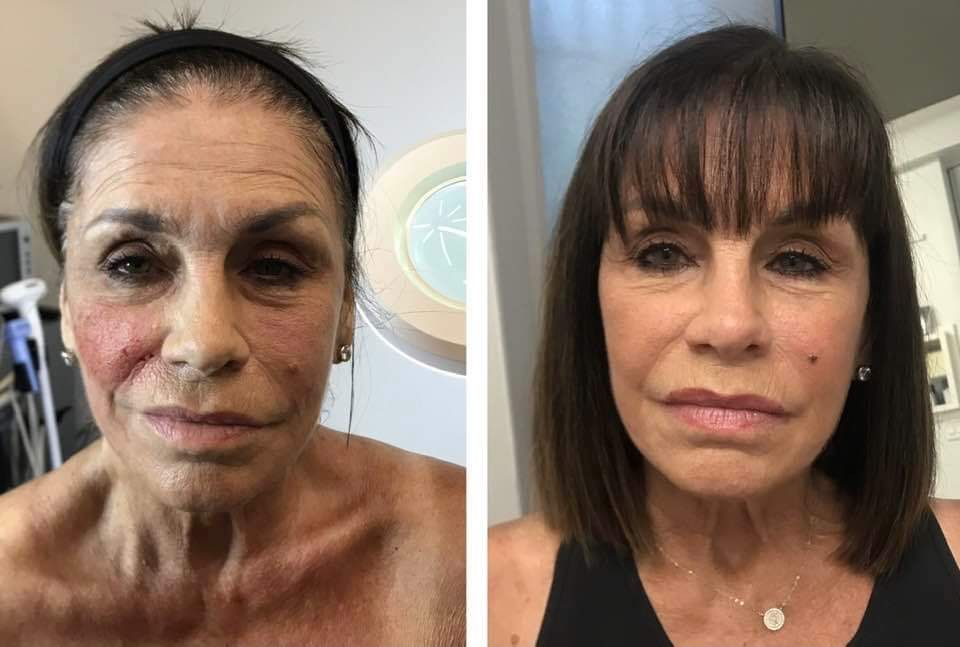 microneedling with radiofrequency, Before and After, Monaco Medspa in Midtown Edgewater Miami, FL, Morpheus Face, Morpheus Eyelids, Morpheus Neck, Photos of Before and After Morpheus8, Monaco med spa in Midtown Edgewater Miami, FL