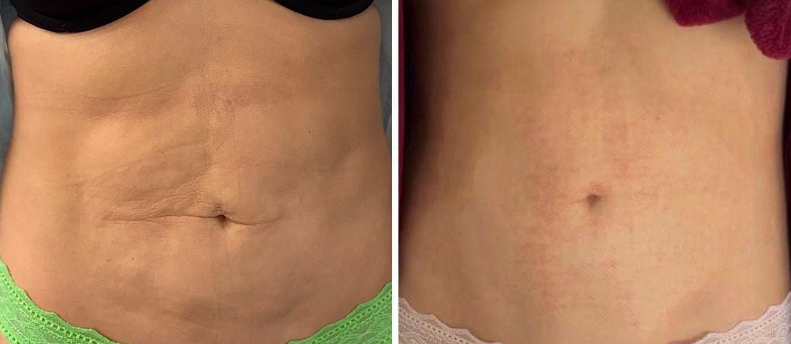 Morpheus8 abdomen, body contouring, body sculpting, microneedling with radiofrequency, Photos of Before and After Morpheus8, Monaco med spa in Midtown Edgewater Miami, FL