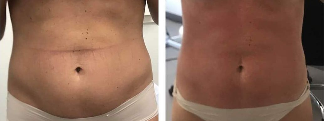 Morpheus8 abdomen, body contouring, body sculpting, microneedling with radiofrequency, Before and After, Monaco Medspa in Midtown Edgewater Miami, FL, Photos of Before and After Morpheus8, Monaco med spa in Midtown Edgewater Miami, FL