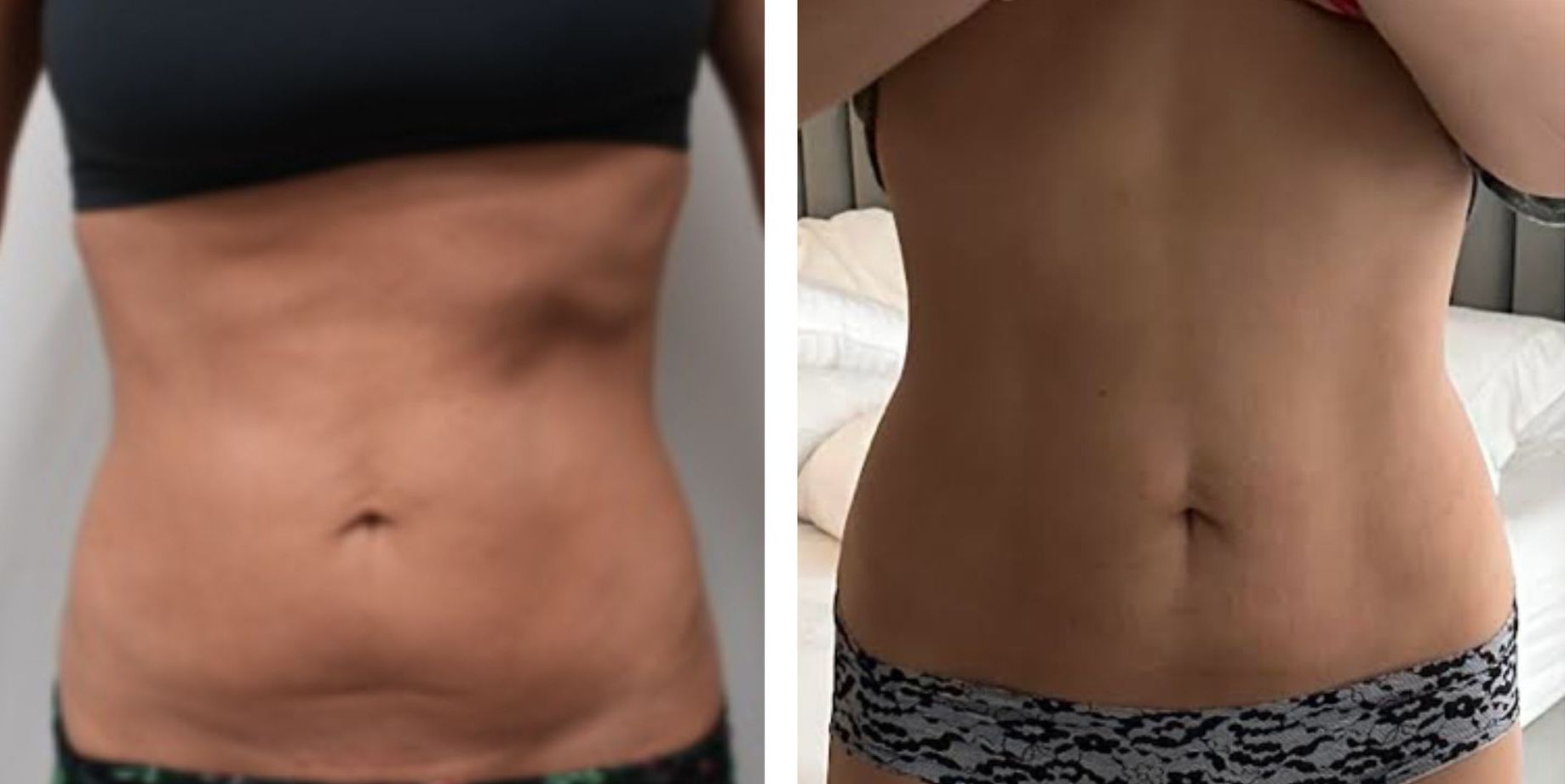 Morpheus8 abdomen, body contouring, body sculpting, microneedling with radiofrequency, Before and After, Monaco Medspa in Midtown Edgewater Miami, FL, Photos of Before and After Morpheus8, Monaco med spa in Midtown Edgewater Miami, FL