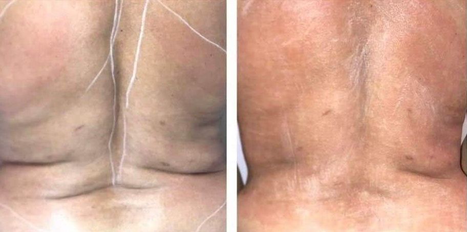 Morpheus8 back, morphues8 bra fat, morpheus8 back fat, body contouring, body sculpting, microneedling with radiofrequency, Before and After, Monaco Medspa in Midtown Edgewater Miami, FL, Photos of Before and After Morpheus8, Monaco med spa in Midtown Edgewater Miami, FL