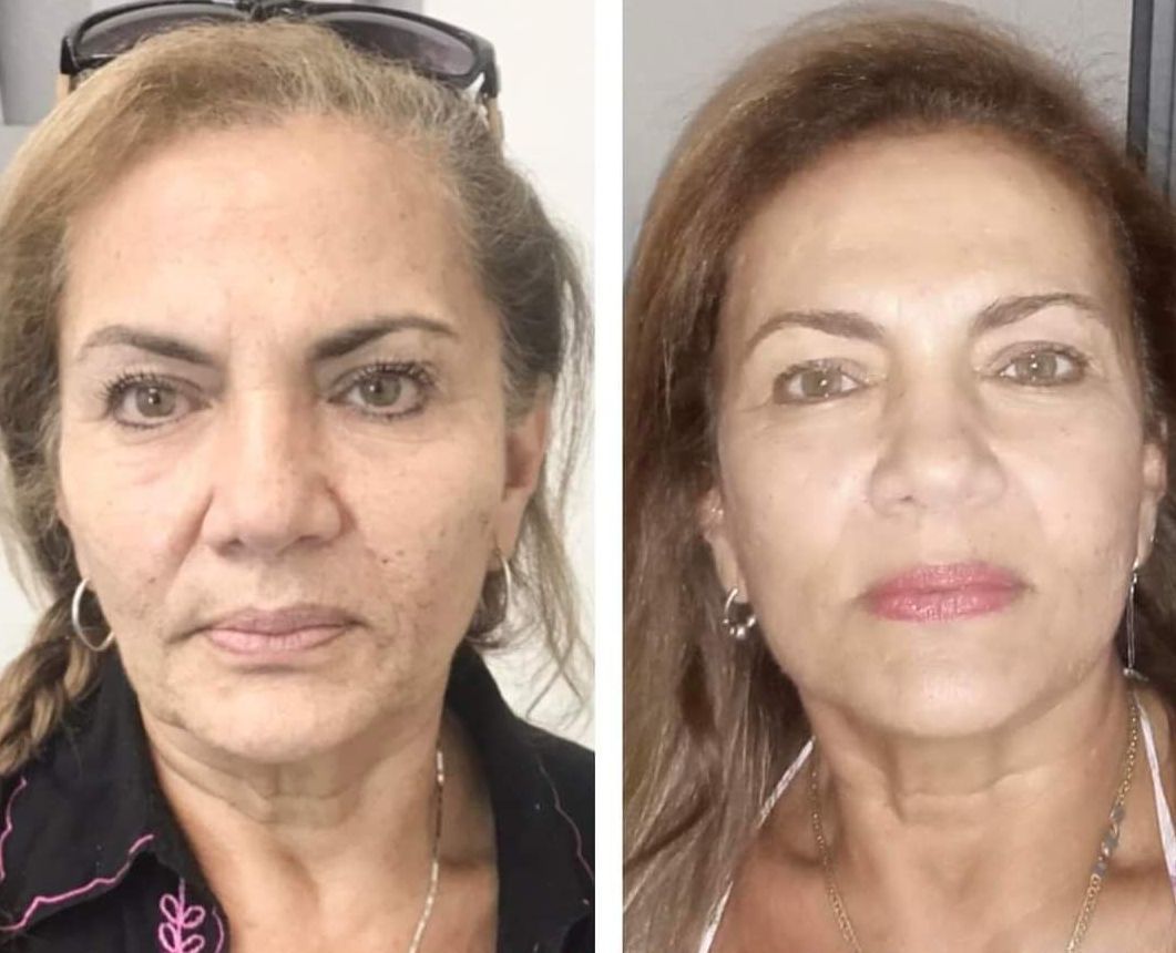 microneedling with radiofrequency, Before and After, Monaco Medspa in Midtown Edgewater Miami, FL, Morpheus8 Face, Morpheus8 Eyelids, Morpheus8 Neck, Photos of Before and After Morpheus8, Monaco med spa in Midtown Edgewater Miami, FL