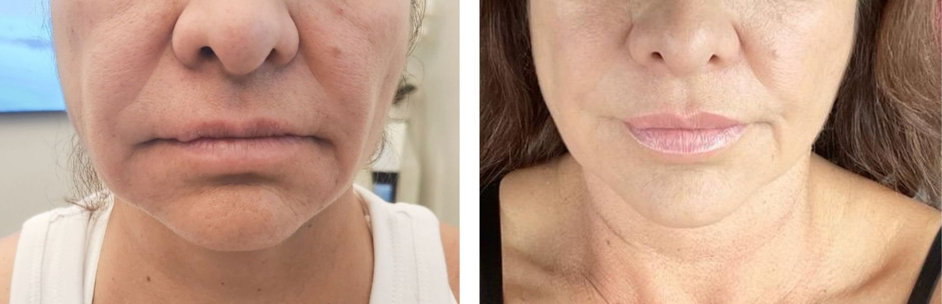 microneedling with radiofrequency, , Morpheus8 Face, Morpheus8 Nose, Before & 5 Days After, Before and After, Monaco Medspa in Midtown Edgewater Miami, FL, Photos of Before and After Morpheus8, Monaco med spa in Midtown Edgewater Miami, FL